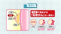 vol.43　増加傾向の乳がん