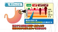 vol.75　日本人に多い胃がん