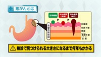 vol.120 日本人に多い胃がん