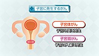 vol.258　子宮頸がんとは
