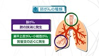 Vol. 278回　肺がんとは