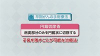 Vol. 478回「子宮頸がんの治療」