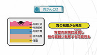 Vol. 560回「胃がんとは」