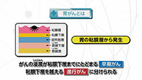 Vol. 584回「胃がんとは」